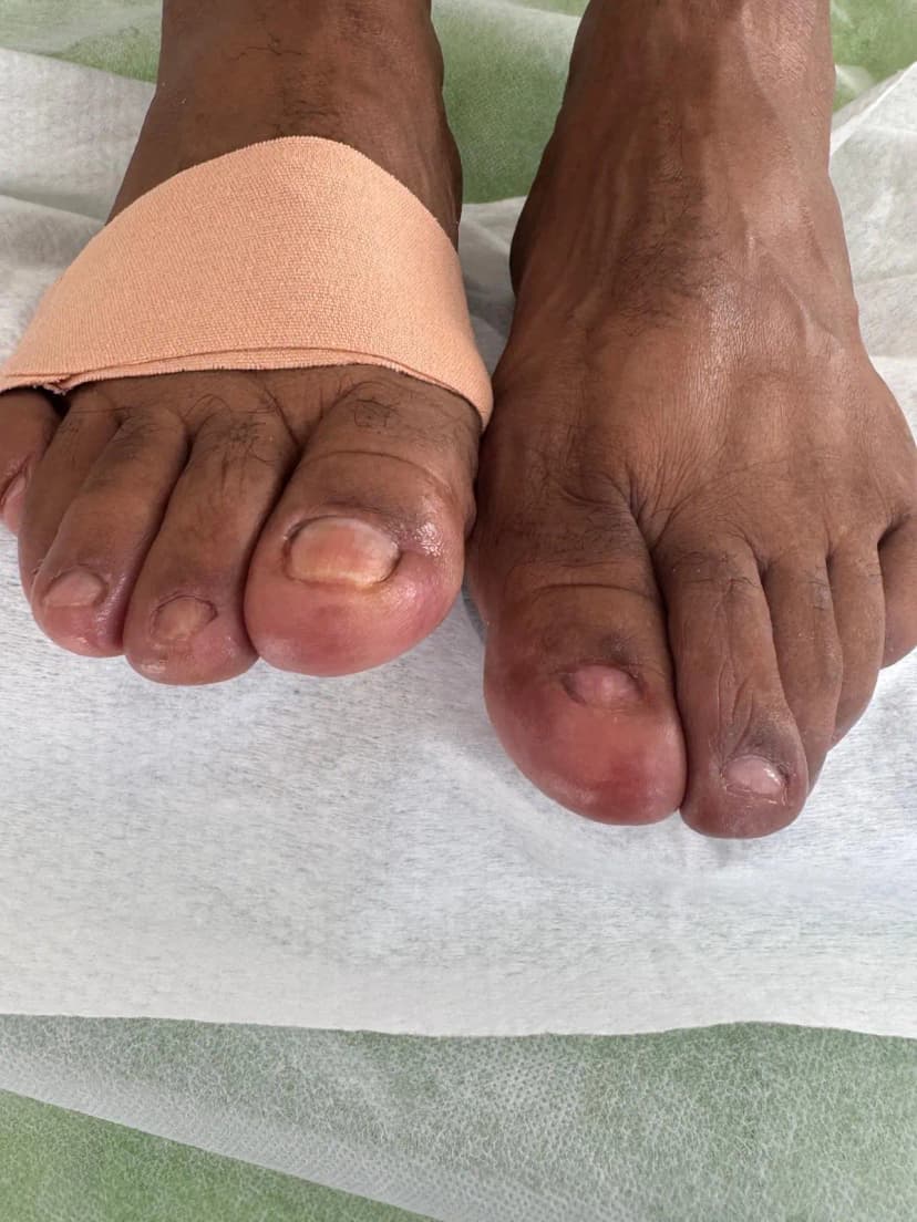 אחרי - יבלת שורש