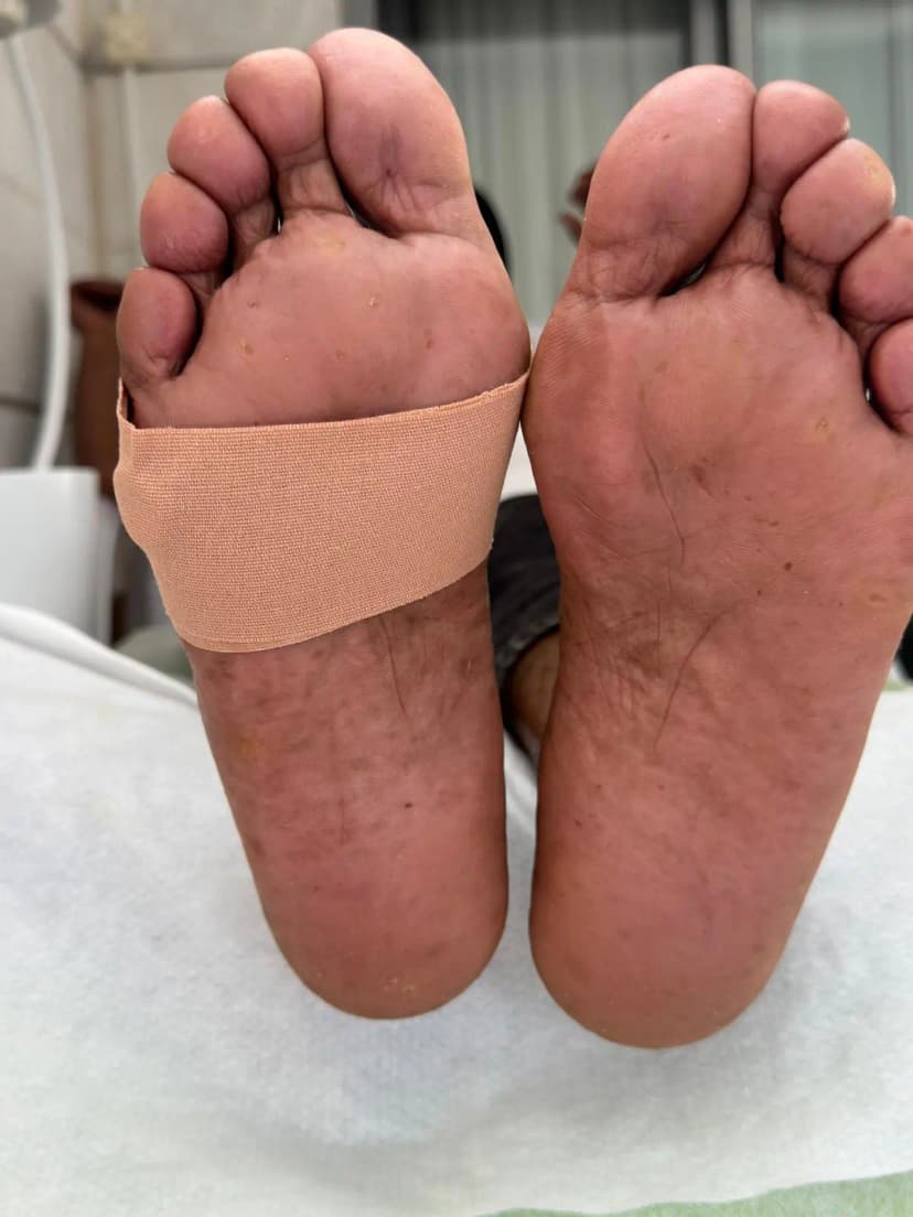 לפני - יבלת שורש